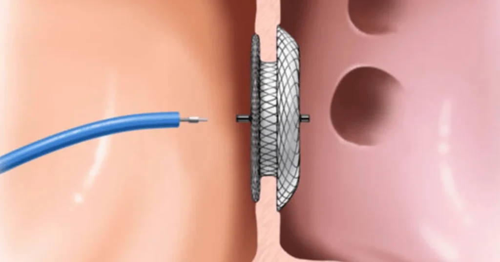Cardiologist performing ASD device closure procedure at EPIC Hospital Ahmedabad