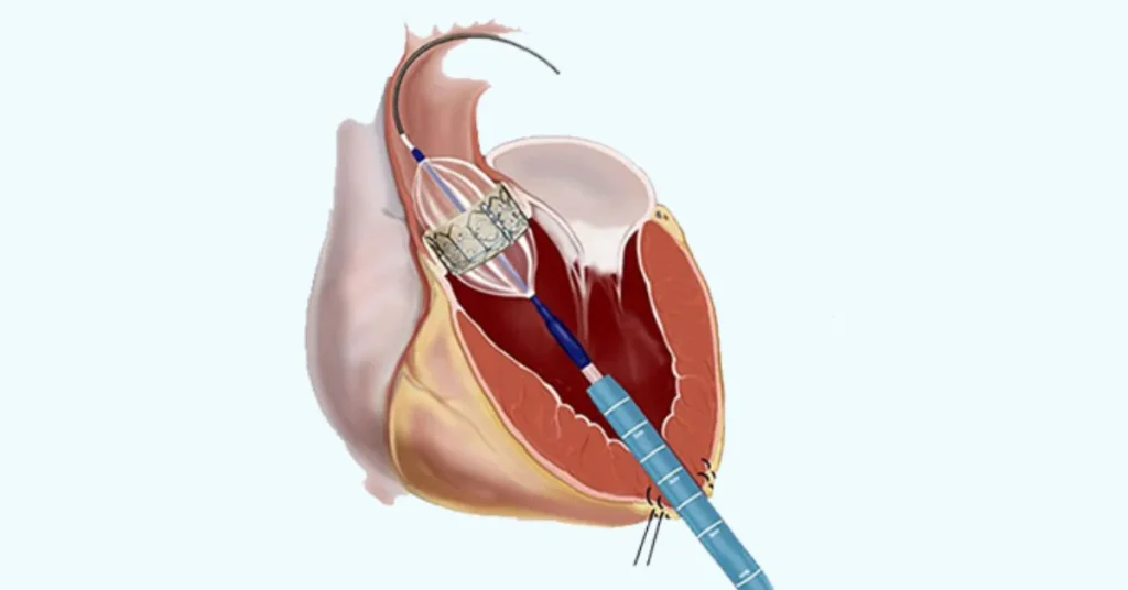 Interventional cardiologist performing balloon valvuloplasty at EPIC Hospital Ahmedabad
