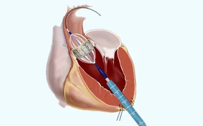Interventional cardiologist performing balloon valvuloplasty at EPIC Hospital Ahmedabad