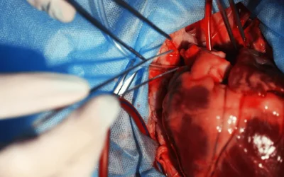 Interventional cardiologist performing balloon valvuloplasty at EPIC Hospital Ahmedabad