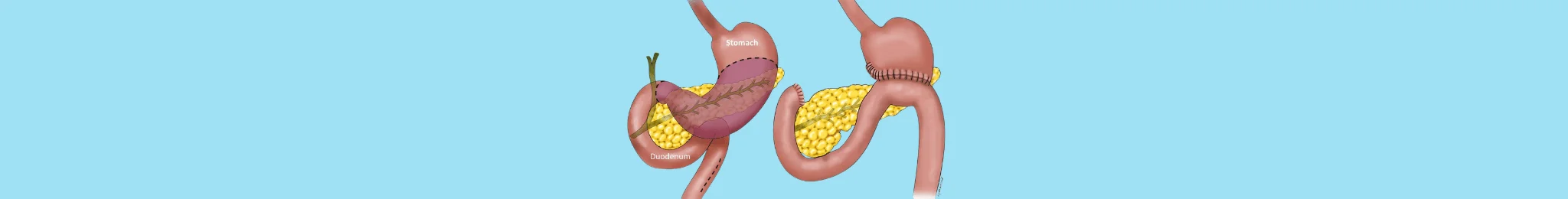 GI Cancer Surgery in Ahmedabad