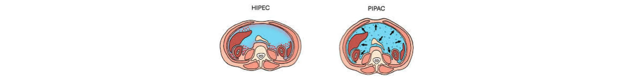 HIPEC PIPAC Treatment in Ahmedabad