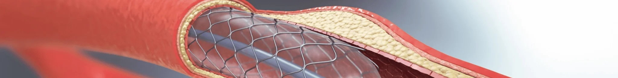 Interventional Cardiac Treatment in Ahmedabad
