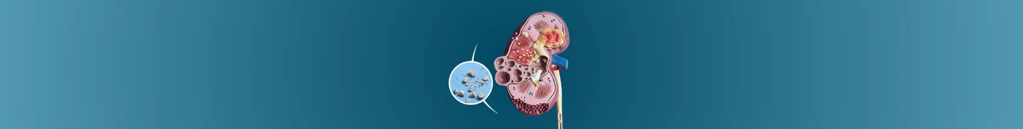 Kidney Stone Treatment in Ahmedabad
