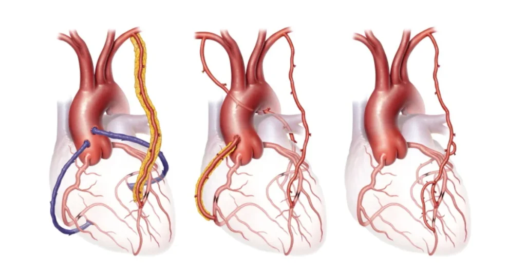 Cardiac surgeon performing LIMA BIMA arterial grafting during bypass surgery at EPIC Hospital Ahmedabad