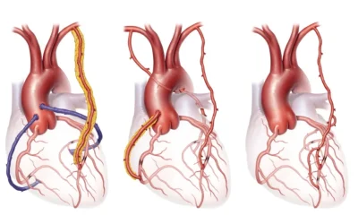 Cardiac surgeon performing LIMA BIMA arterial grafting during bypass surgery at EPIC Hospital Ahmedabad