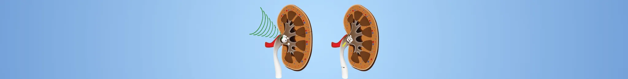 Lithotripsy Stone Treatment in Ahmedabad