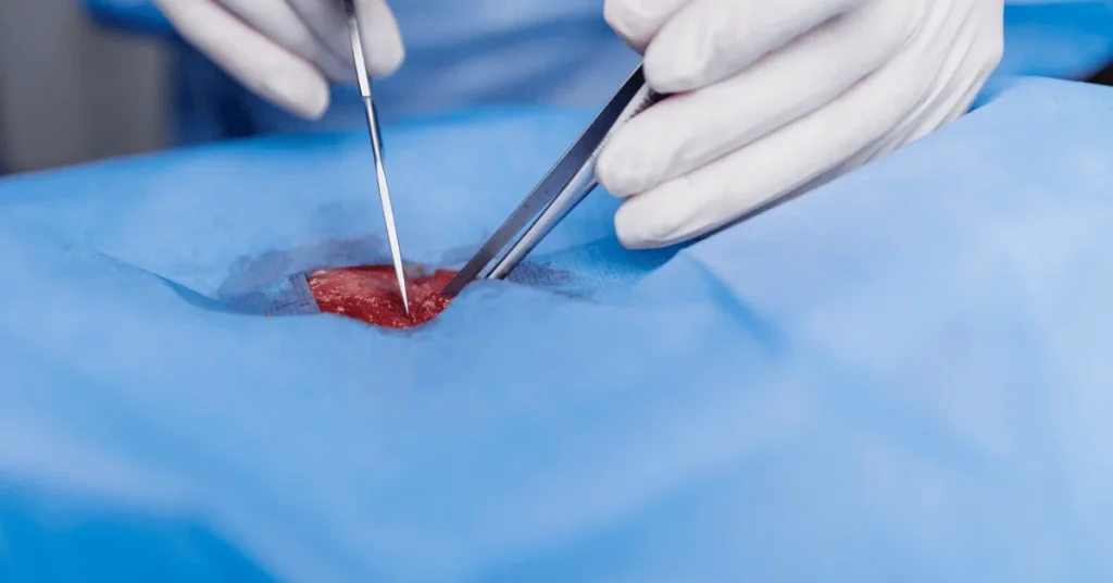 Minimally invasive cancer surgery being performed at EPIC Hospital Ahmedabad