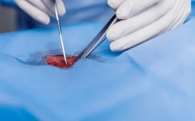 Minimally invasive cancer surgery being performed at EPIC Hospital Ahmedabad