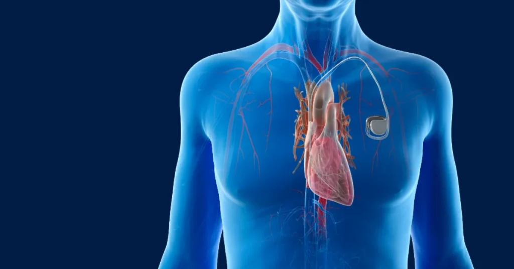 Cardiologist performing pacemaker implantation procedure at EPIC Hospital Ahmedabad