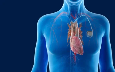 Cardiologist performing pacemaker implantation procedure at EPIC Hospital Ahmedabad