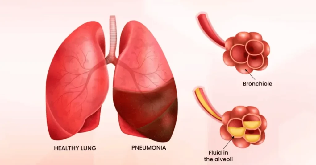 Doctor reviewing a chest X-ray showing pneumonia at EPIC Hospital Ahmedabad