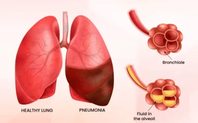 Doctor reviewing a chest X-ray showing pneumonia at EPIC Hospital Ahmedabad