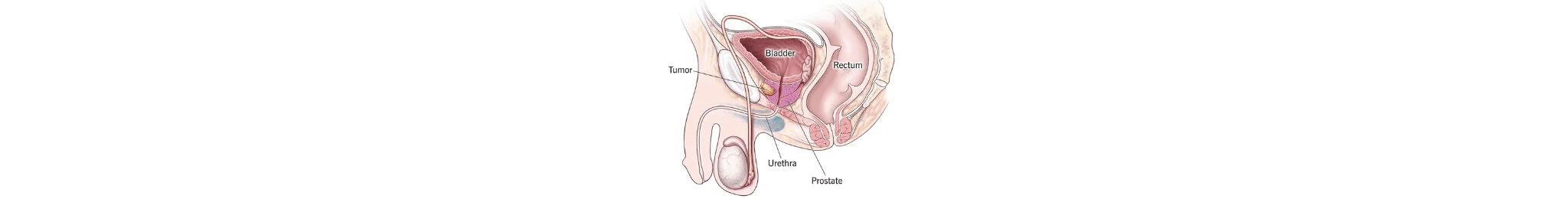 Prostate Cancer Treatment in Ahmedabad