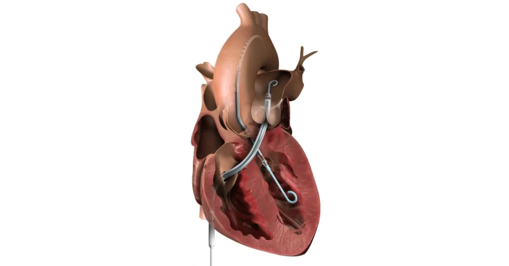 Structural heart team performing TAVAR procedure at EPIC Multispecialty Hospital Ahmedabad
