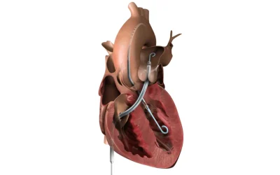Structural heart team performing TAVAR procedure at EPIC Multispecialty Hospital Ahmedabad