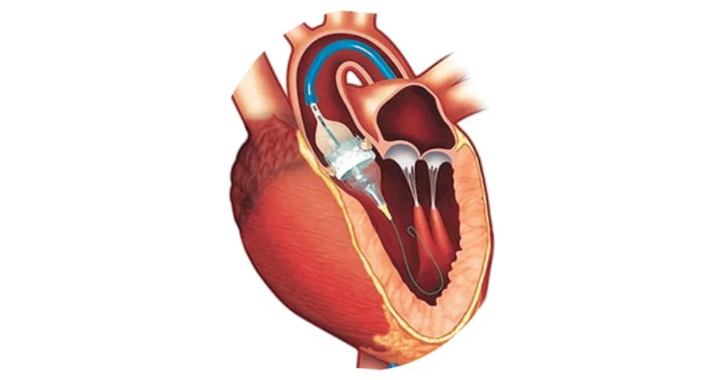 Structural heart team performing TAVI treatment at EPIC Hospital Ahmedabad