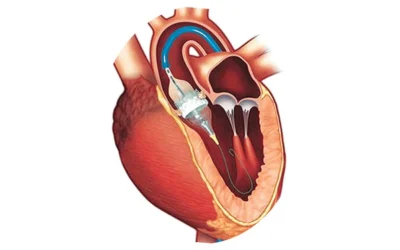 Structural heart team performing TAVI treatment at EPIC Hospital Ahmedabad