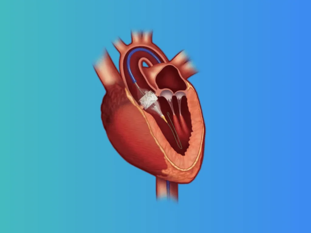 TAVR / TAVI — Getting a New Heart Valve Without Open Surgery