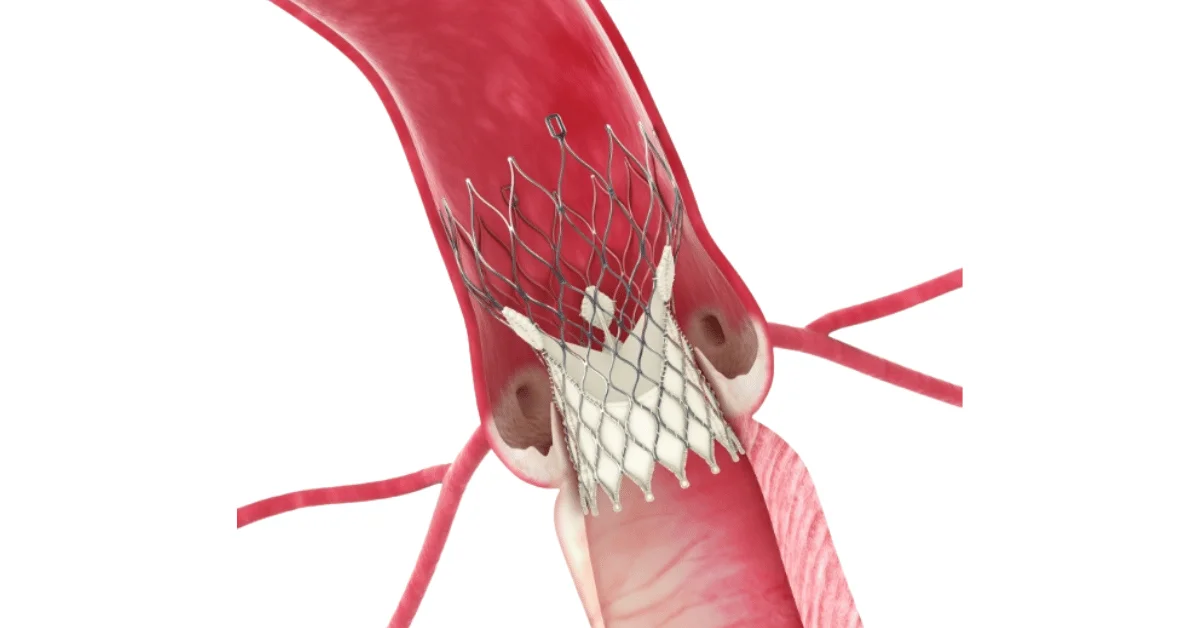 Tavr Program TAVR Treatment in Ahmedabad | EPIC Multispecialty Hospital