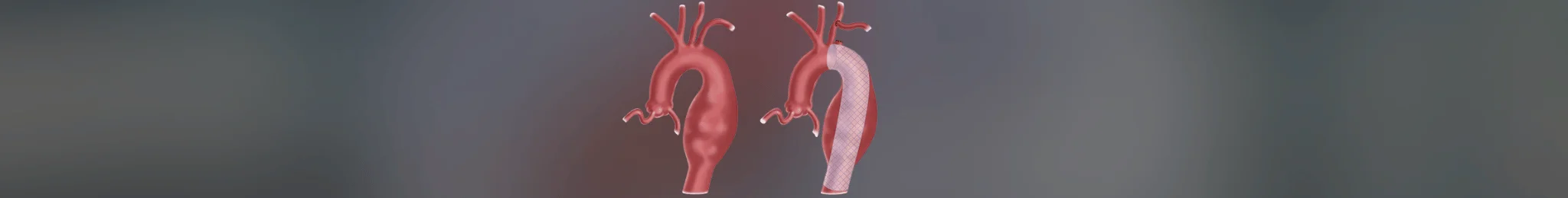 TEVAR Procedure in Ahmedabad