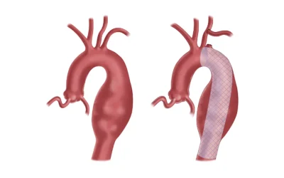 Vascular and cardiac team performing TEVAR procedure at EPIC Hospital Ahmedabad