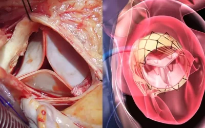 Cardiac surgeon performing valve replacement surgery at EPIC Multispecialty Hospital Ahmedabad