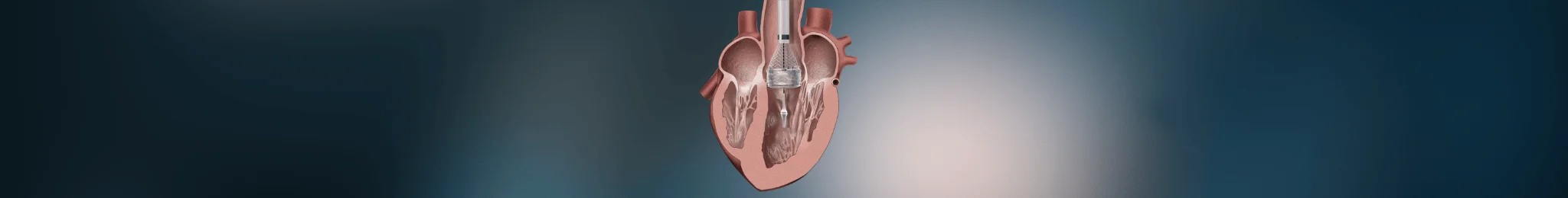 Valve Replacement Surgery in Ahmedabad