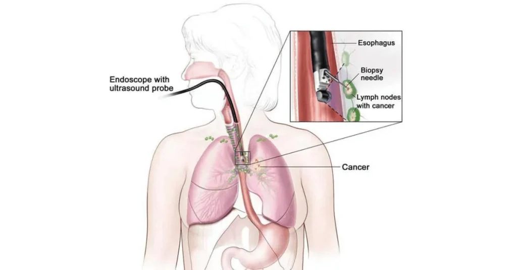 EBUS procedure for advanced lung diagnosis at EPIC Hospital Ahmedabad