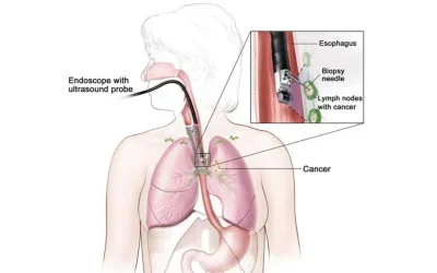 EBUS procedure for advanced lung diagnosis at EPIC Hospital Ahmedabad